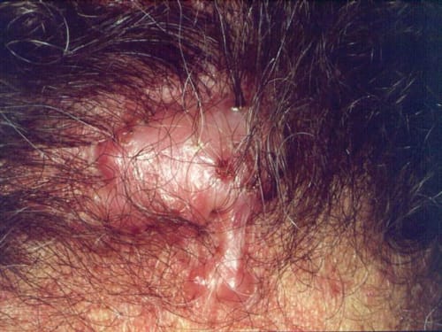 Managing acne keloidalis nuchae (AKN) | British Skin Foundation