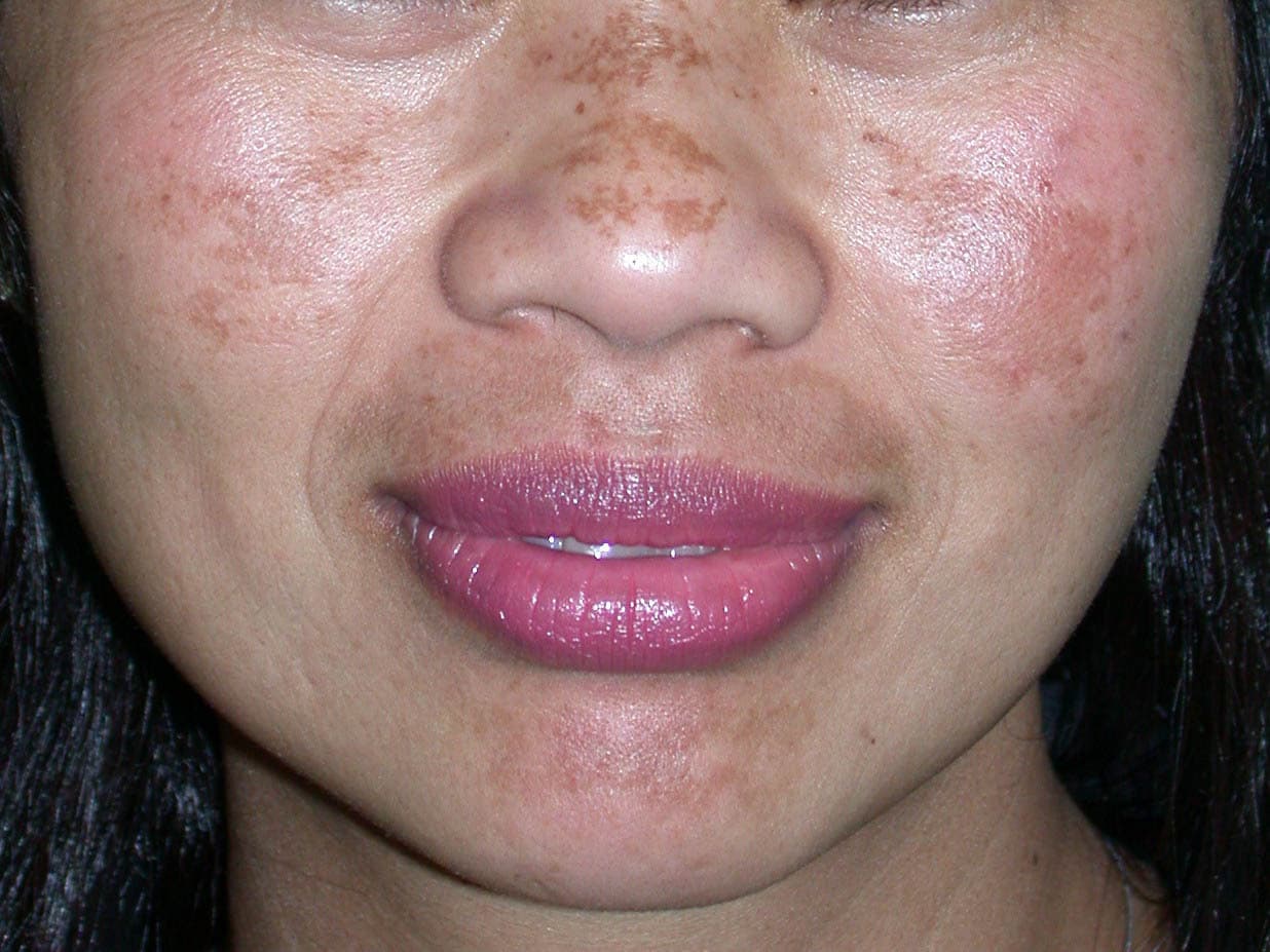 Melasma