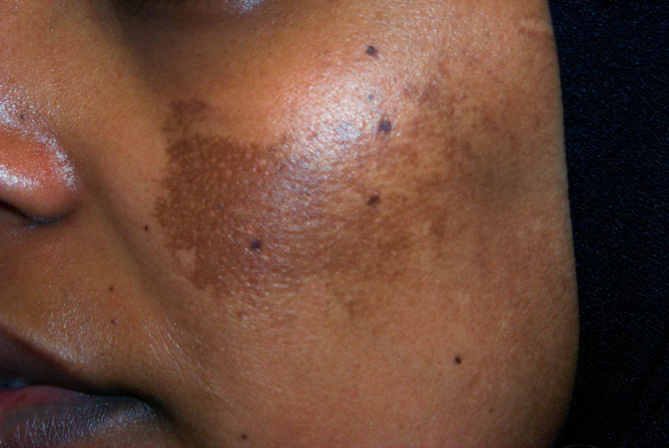 Melasma