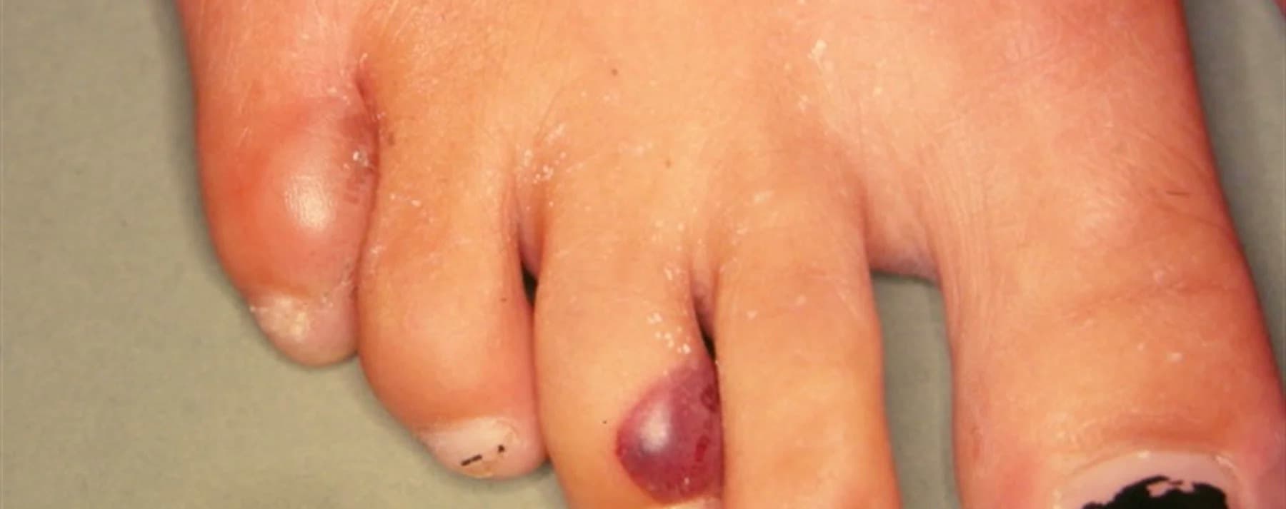 Epidermolysis Bullosa Simplex