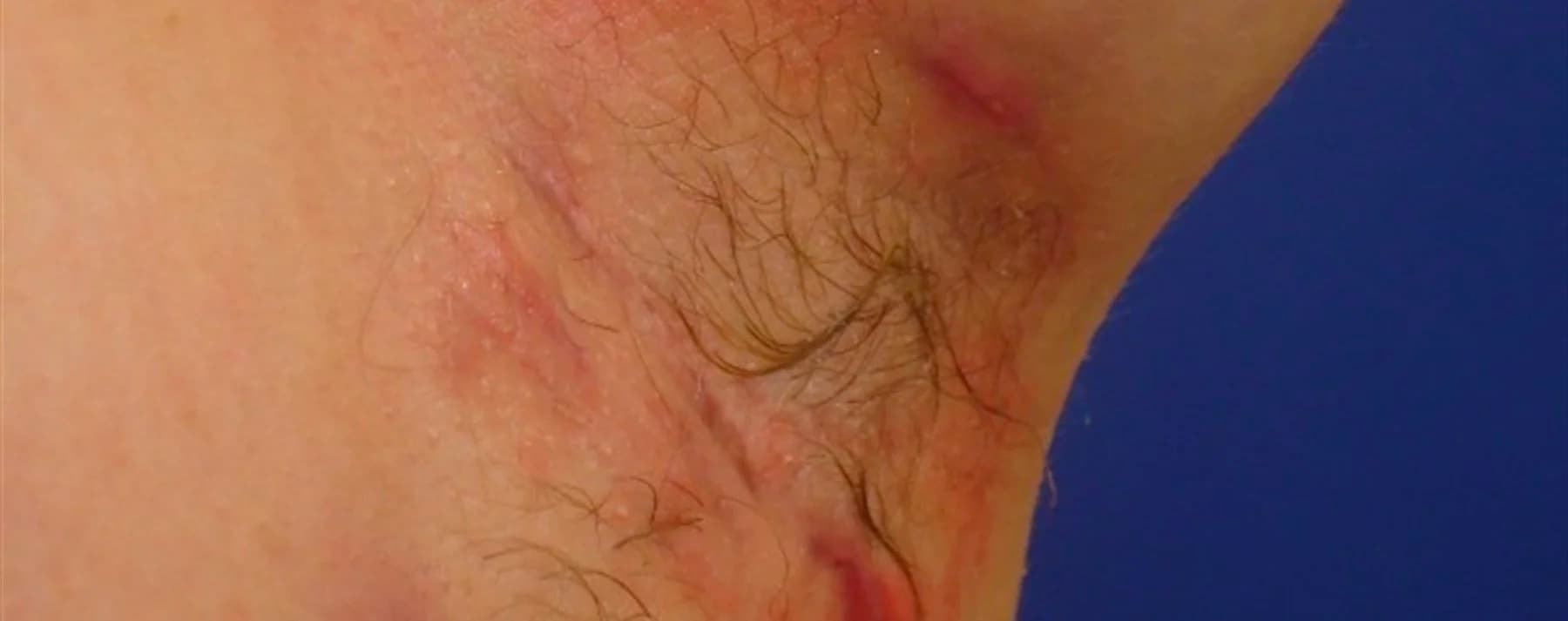 Hidradenitis Suppurativa