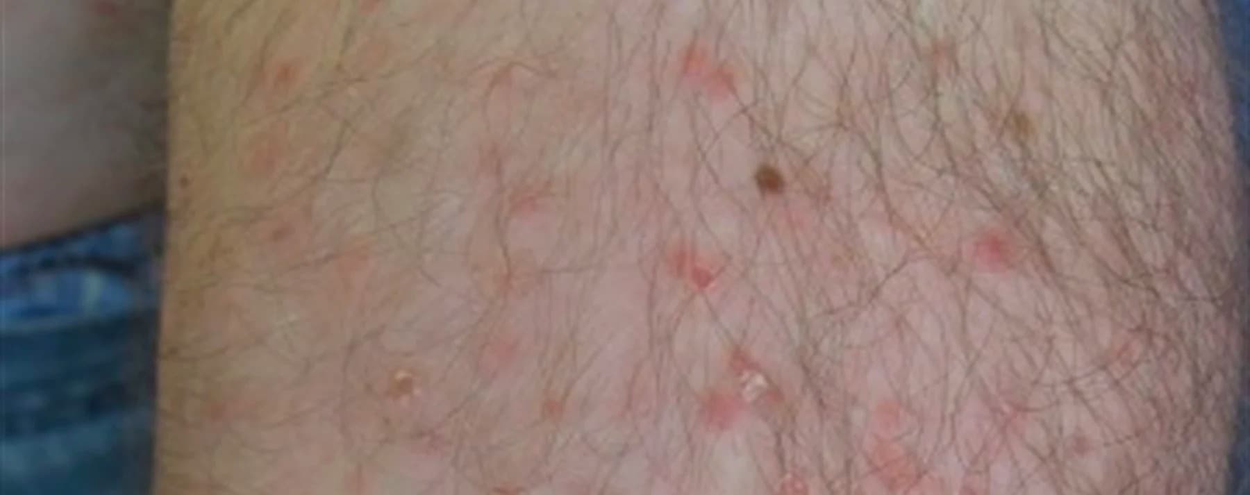 Pityriasis Lichenoides