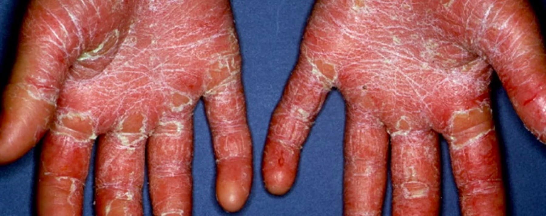 Pityriasis Rubra Pilaris