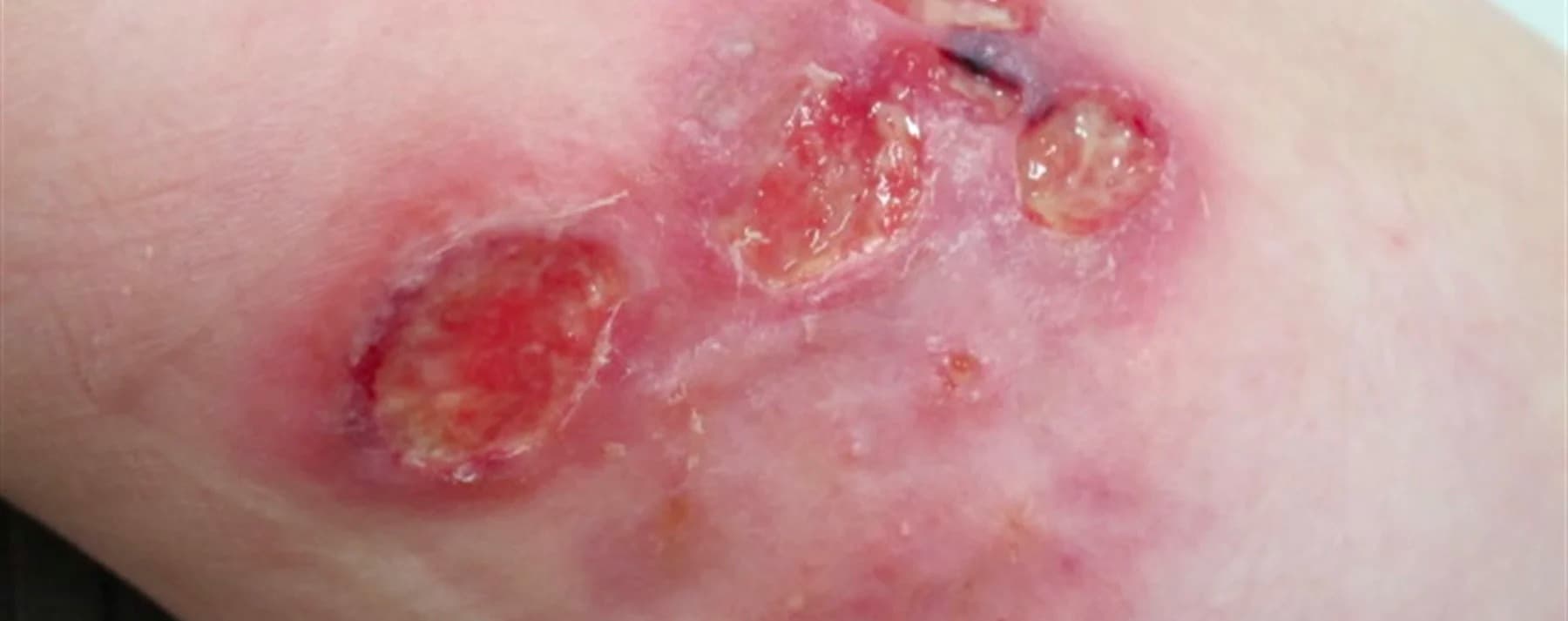 Pyoderma Gangrenosum