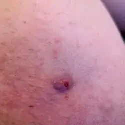 Abscess on Bethan's body which is red and circular.