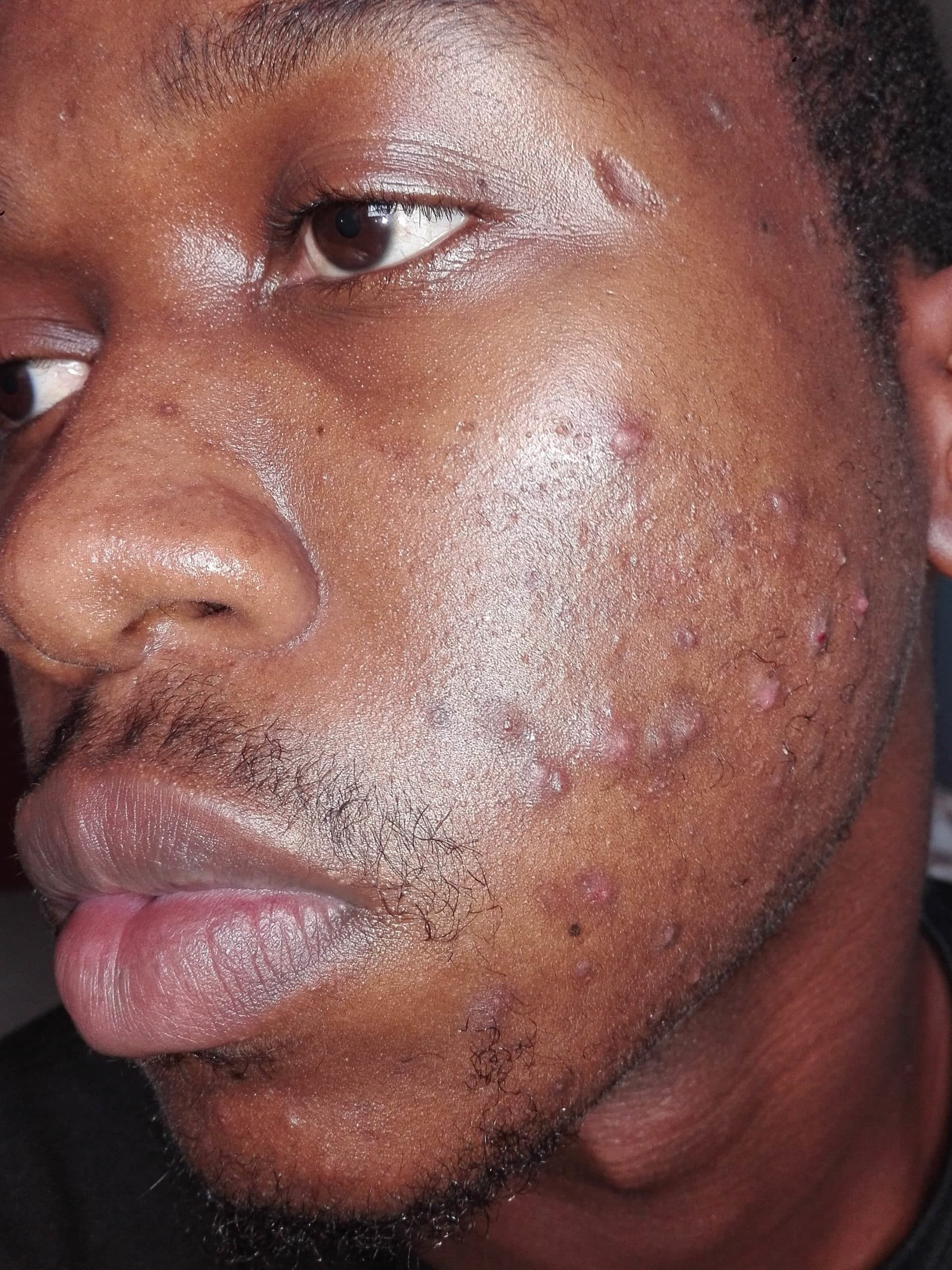 Side of a face with acne