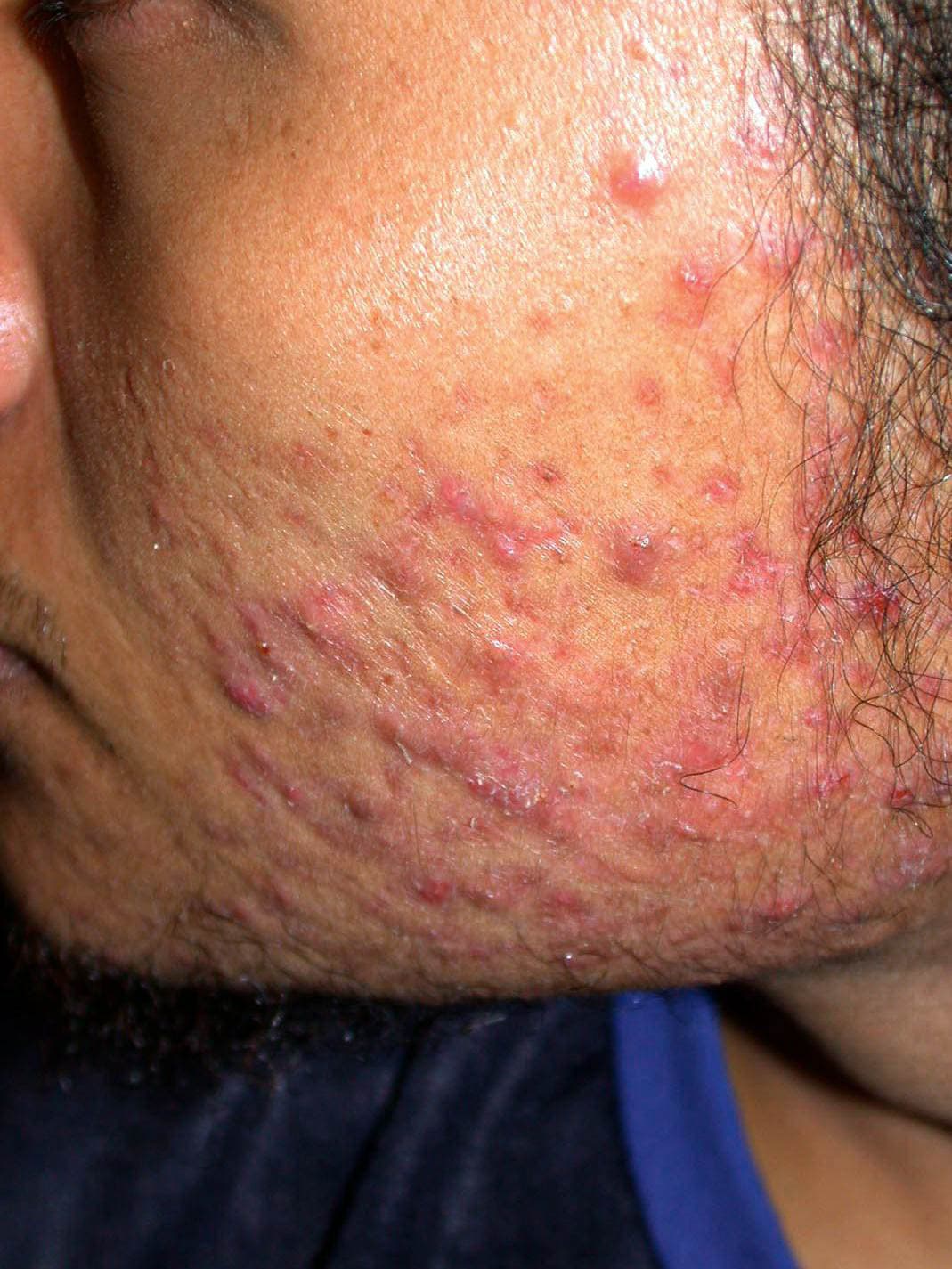 Clinical image of acne on the face of a male with skin of colour.
