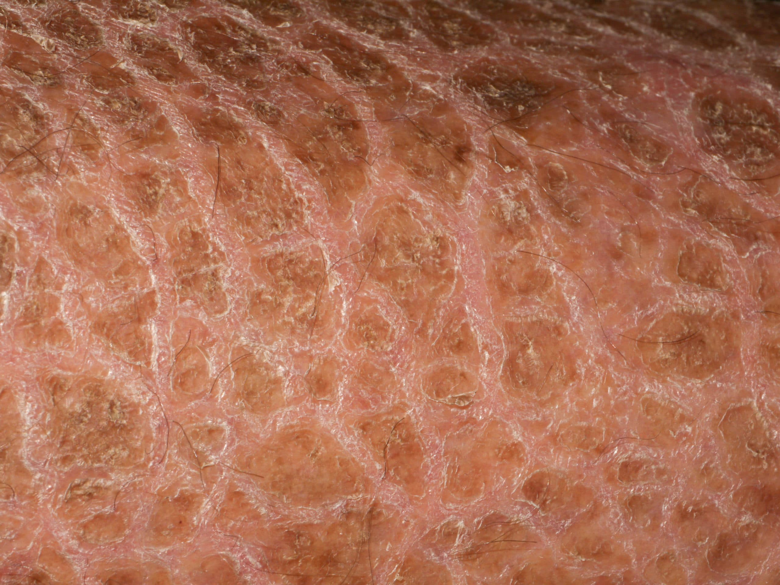 Ichthyosis