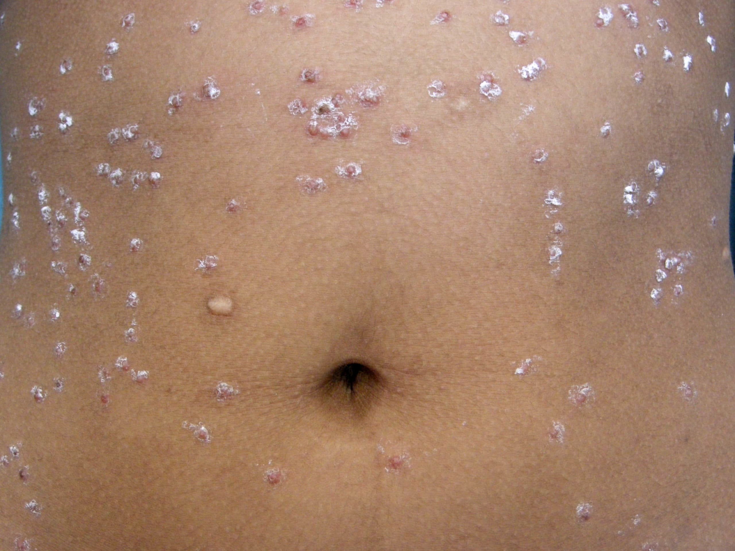Pityriasis lichenoides chronic
