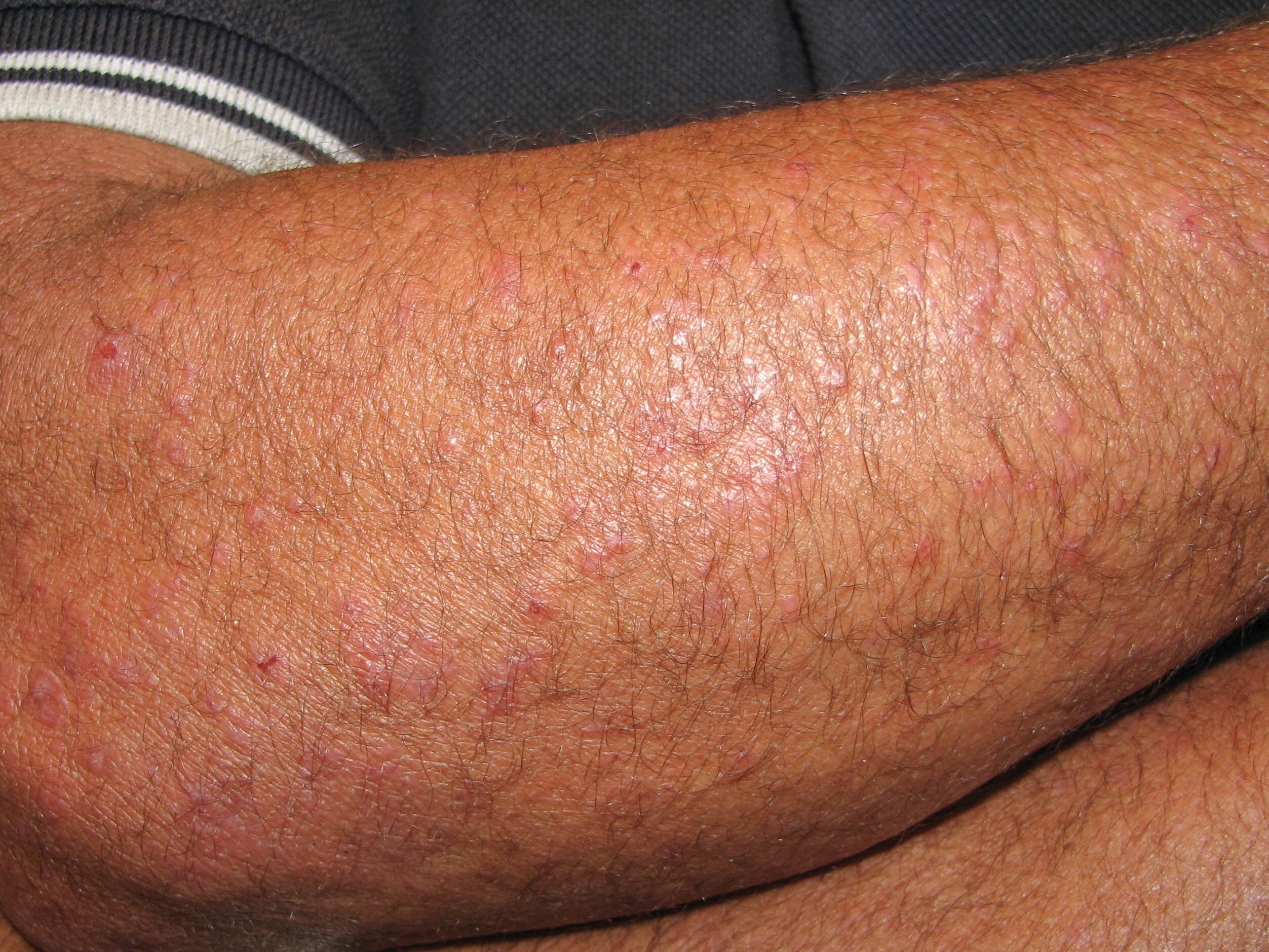 polymorphic light eruption