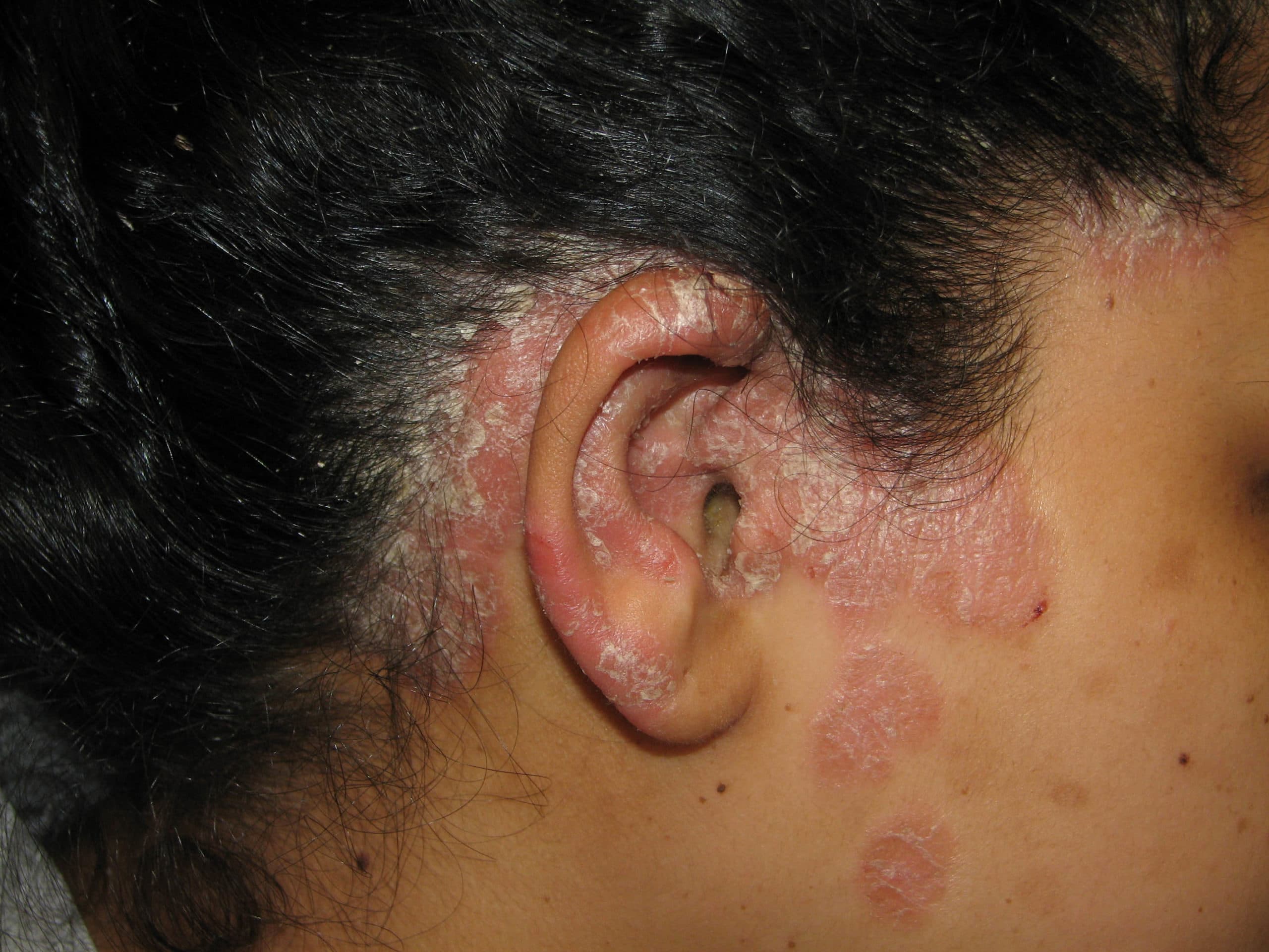 Psoriasis