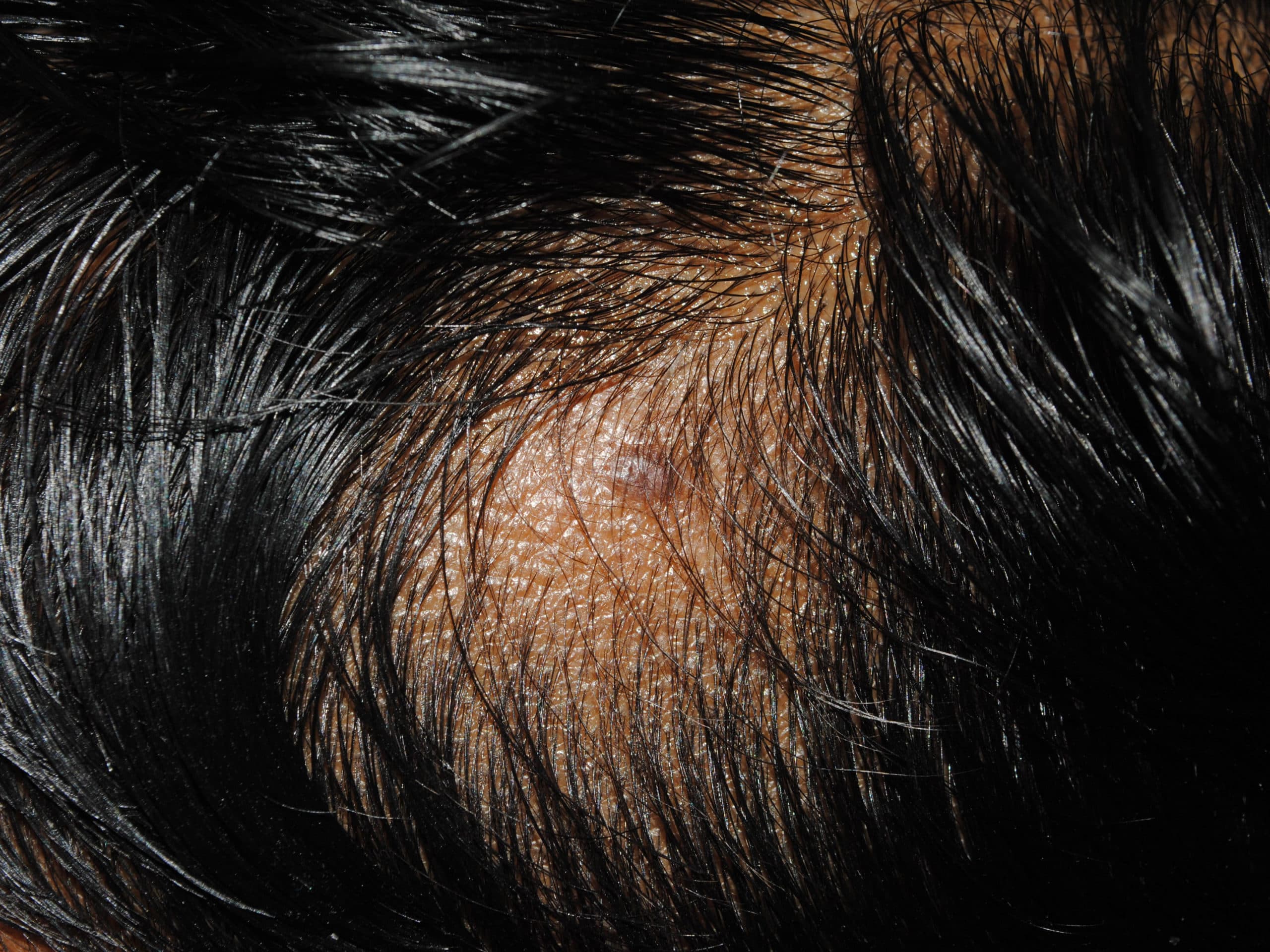 Left Lateral Scalp with alopecia