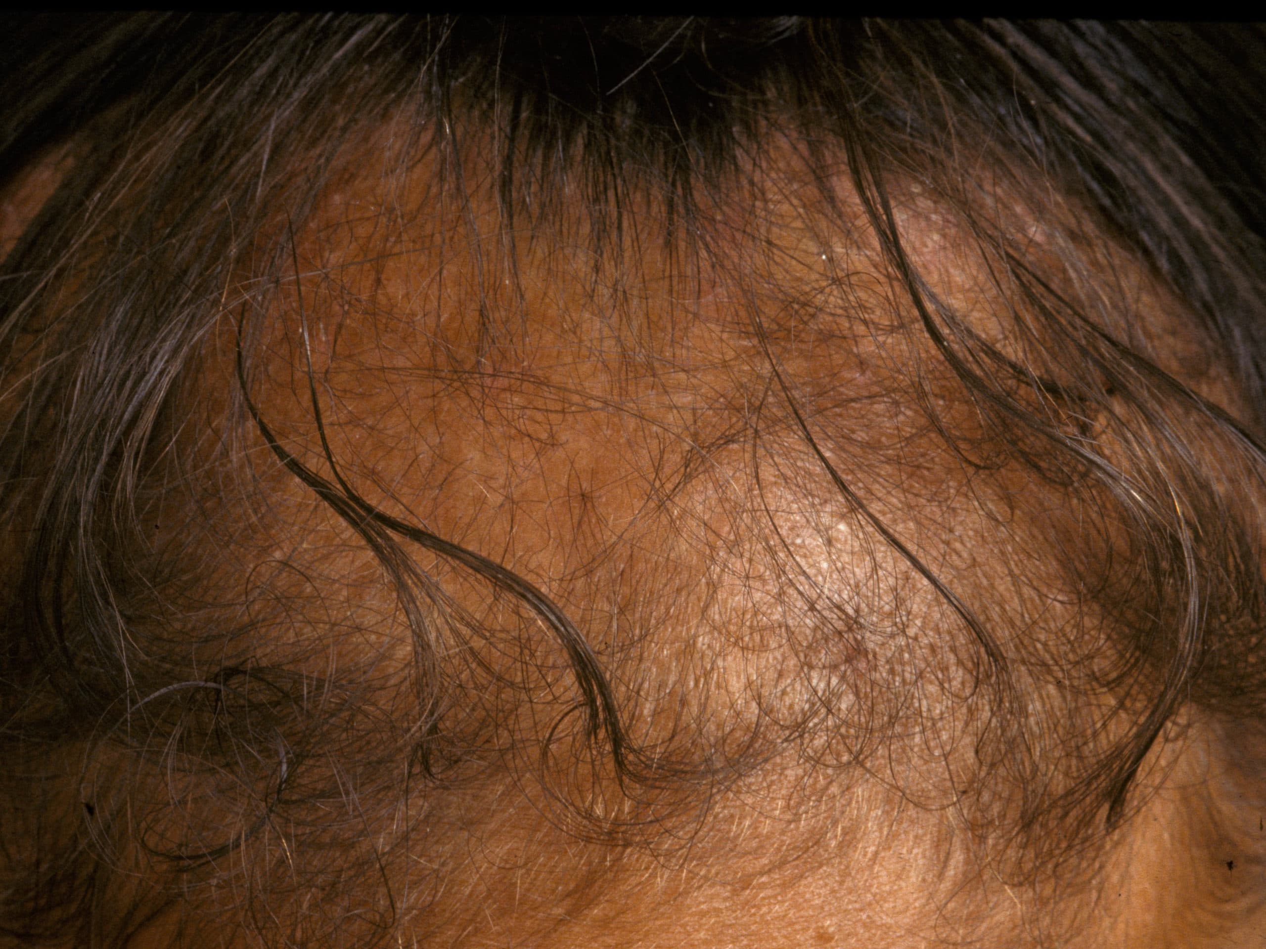 Traction alopecia