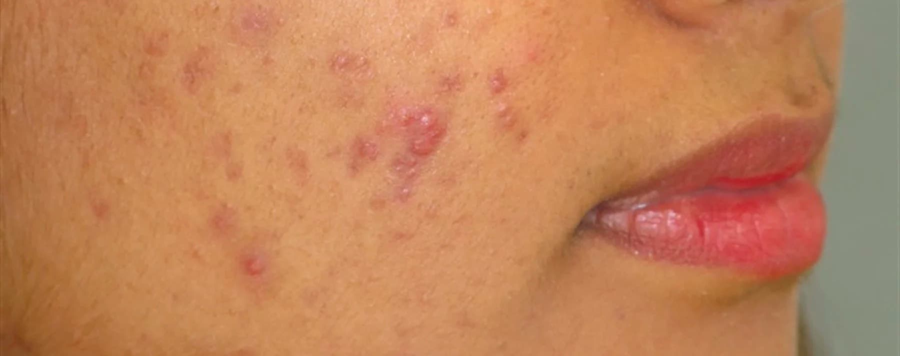 Image of a person with acne