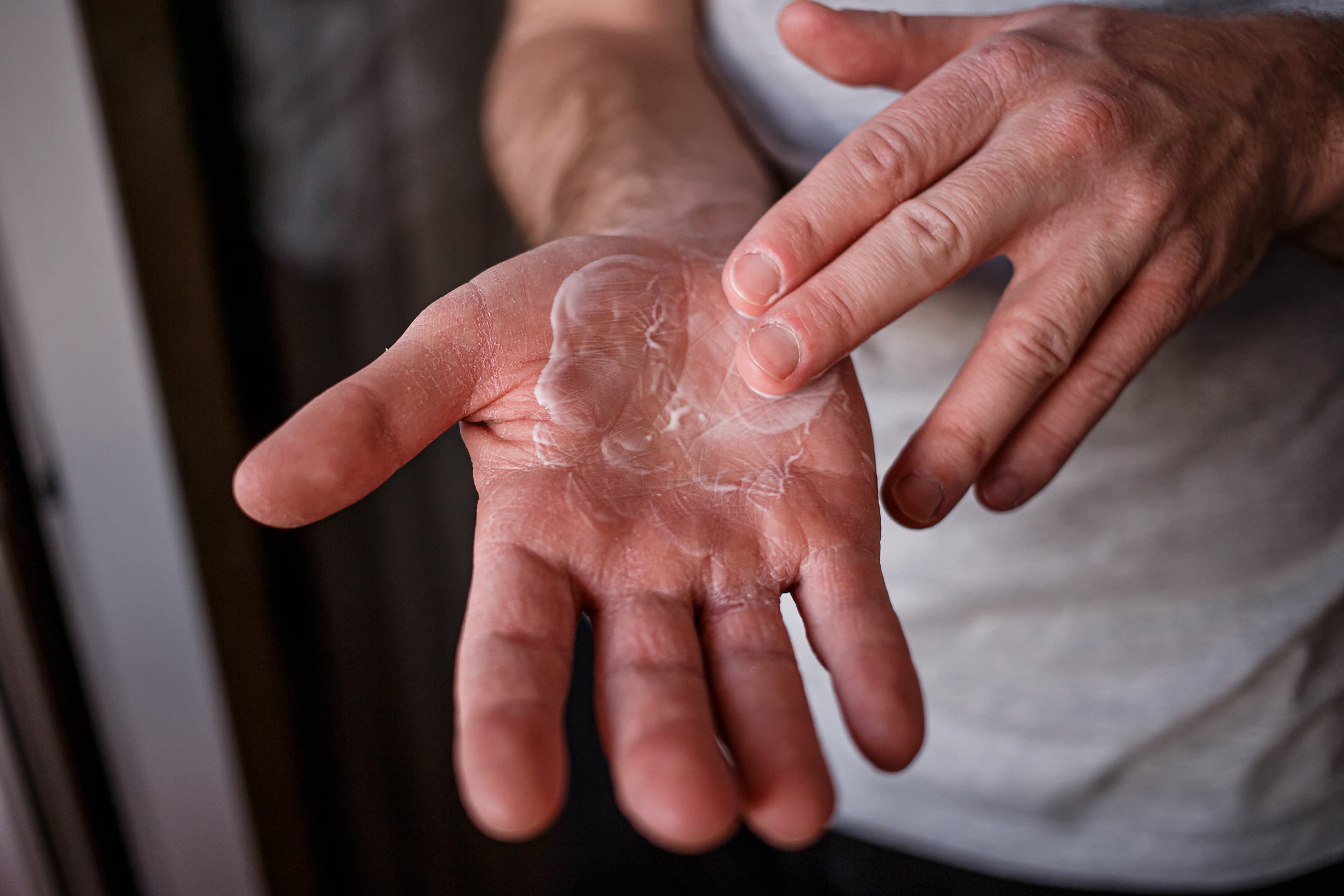 Close-up of hands applying moisturising cream to dry skin on the palm, illustrating skincare treatment for dryness and hand care.
