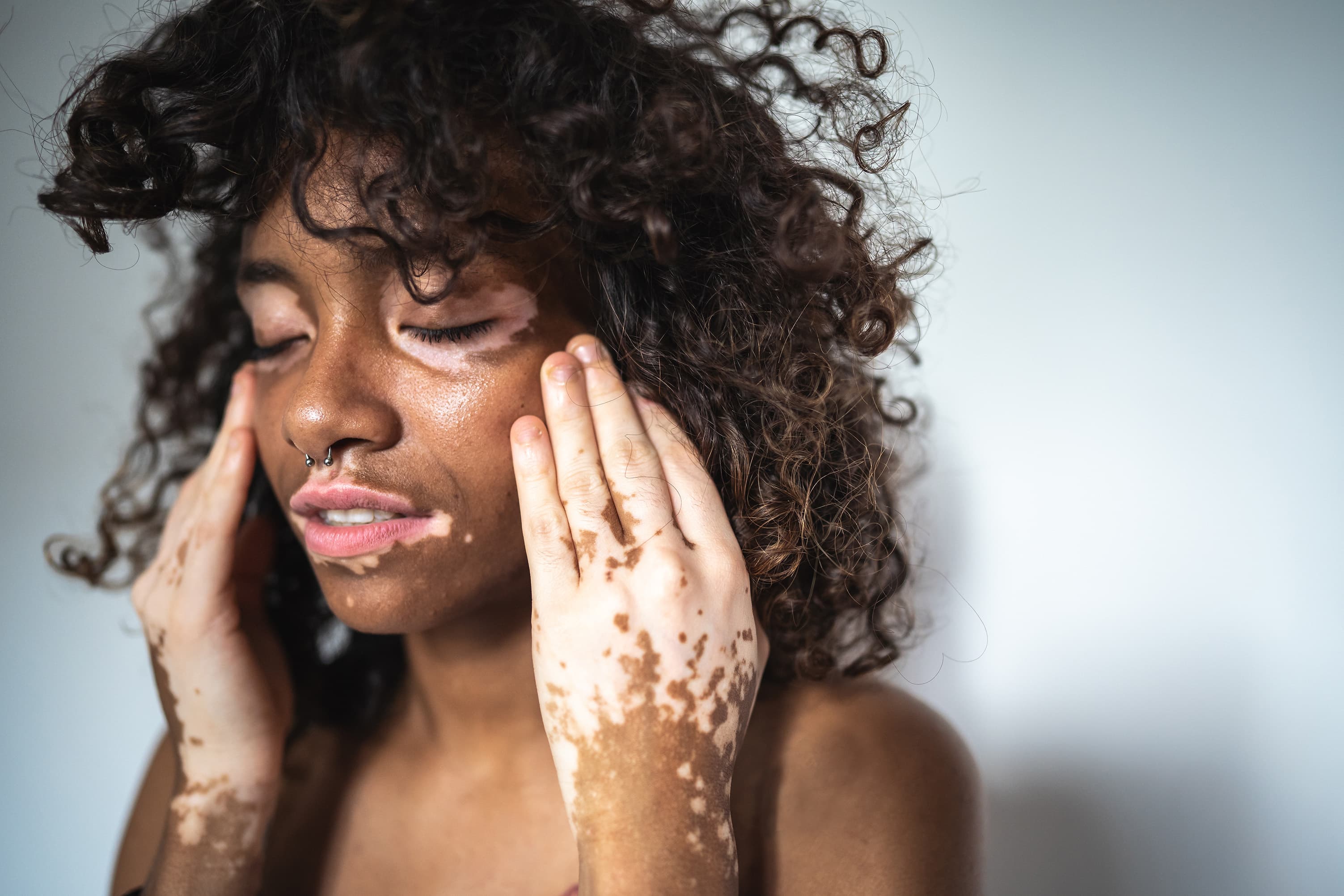Woman with vitiligo gently touching her face with eyes closed, showcasing natural skin variation and inclusive beauty.