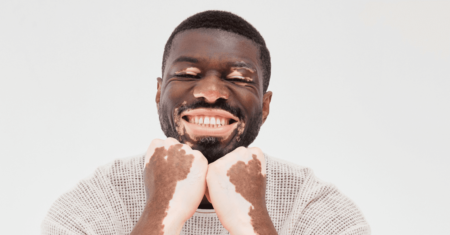Reuben K Sam man smiling with both hands on chin with vitiligo